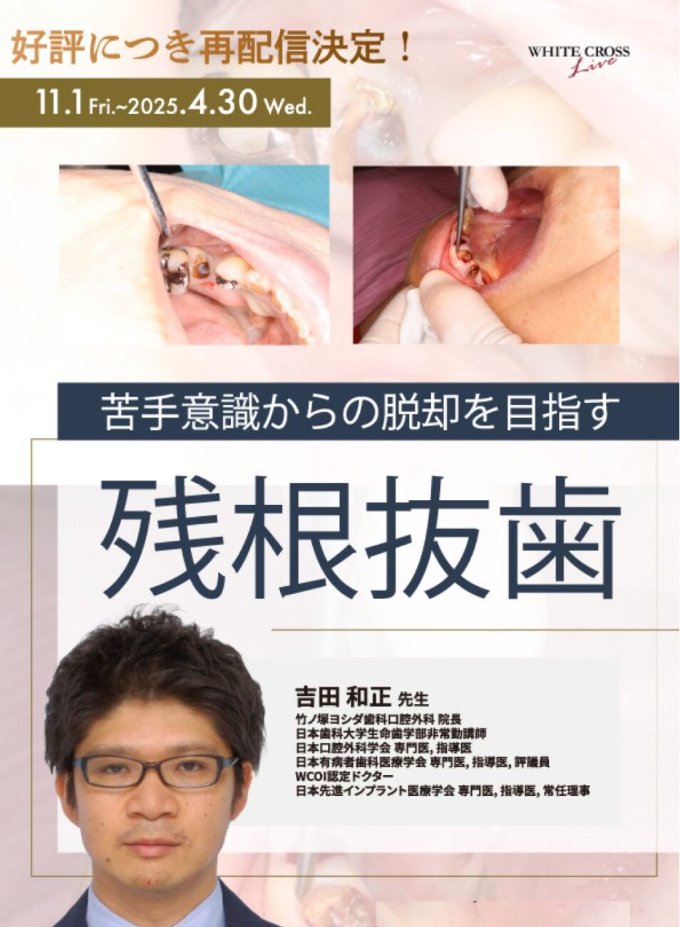 苦手意識からの脱却を目指す残根抜歯 - 那覇市で歯医者をお探しならセレブデンタルオフィスへ